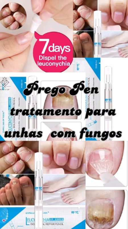 Prego Pen Onicomicose Paroníquia Infecção Herbal Dedo Dedo Do Pé Unhas De Saúde tratamento para unhas #tratamentoparaunhas #TratamentoDeFungos #caneta