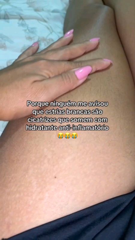 Creme anti-estrias#cremeantiestrias #beleza #estrias #tiraestrias
